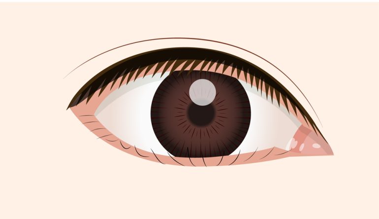 眼瞼内反症（逆さまつ毛）