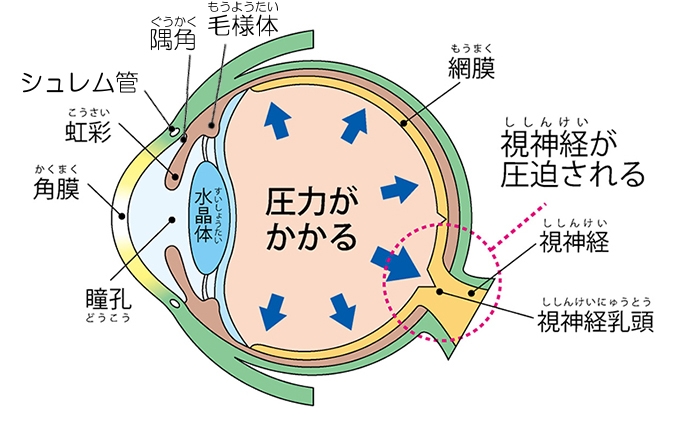 緑内障