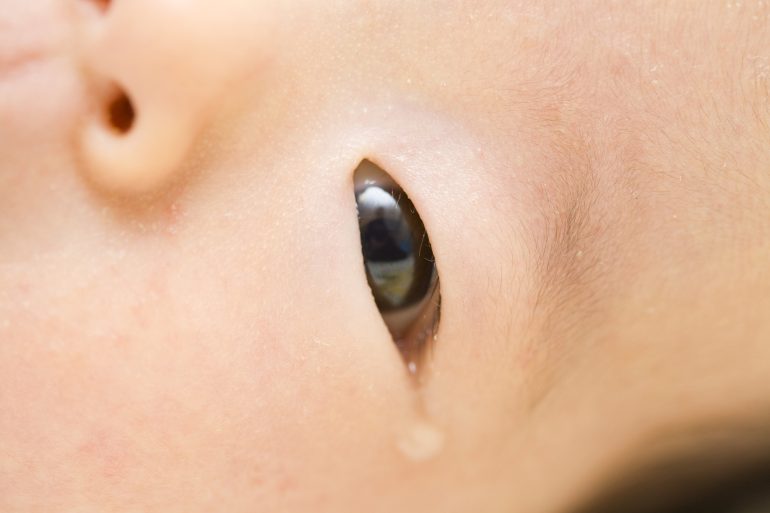 乳児の先天性鼻涙管閉塞