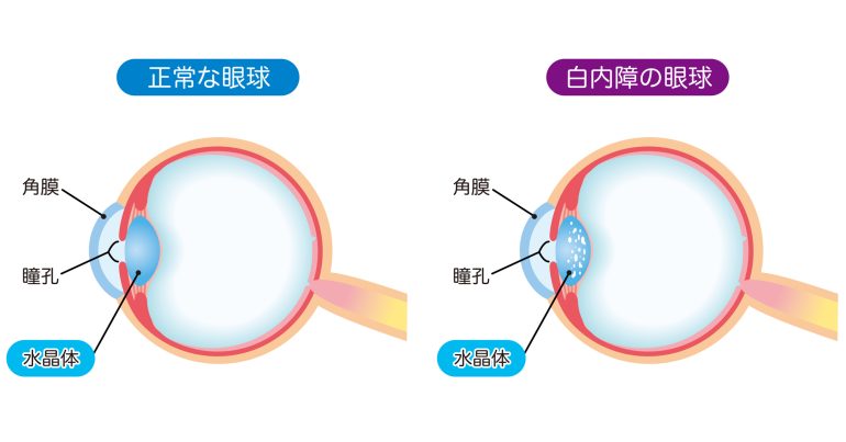 白内障とは？